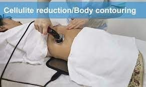 Person receiving a cellulite reduction and body contouring treatment on their abdomen with a specialized device.