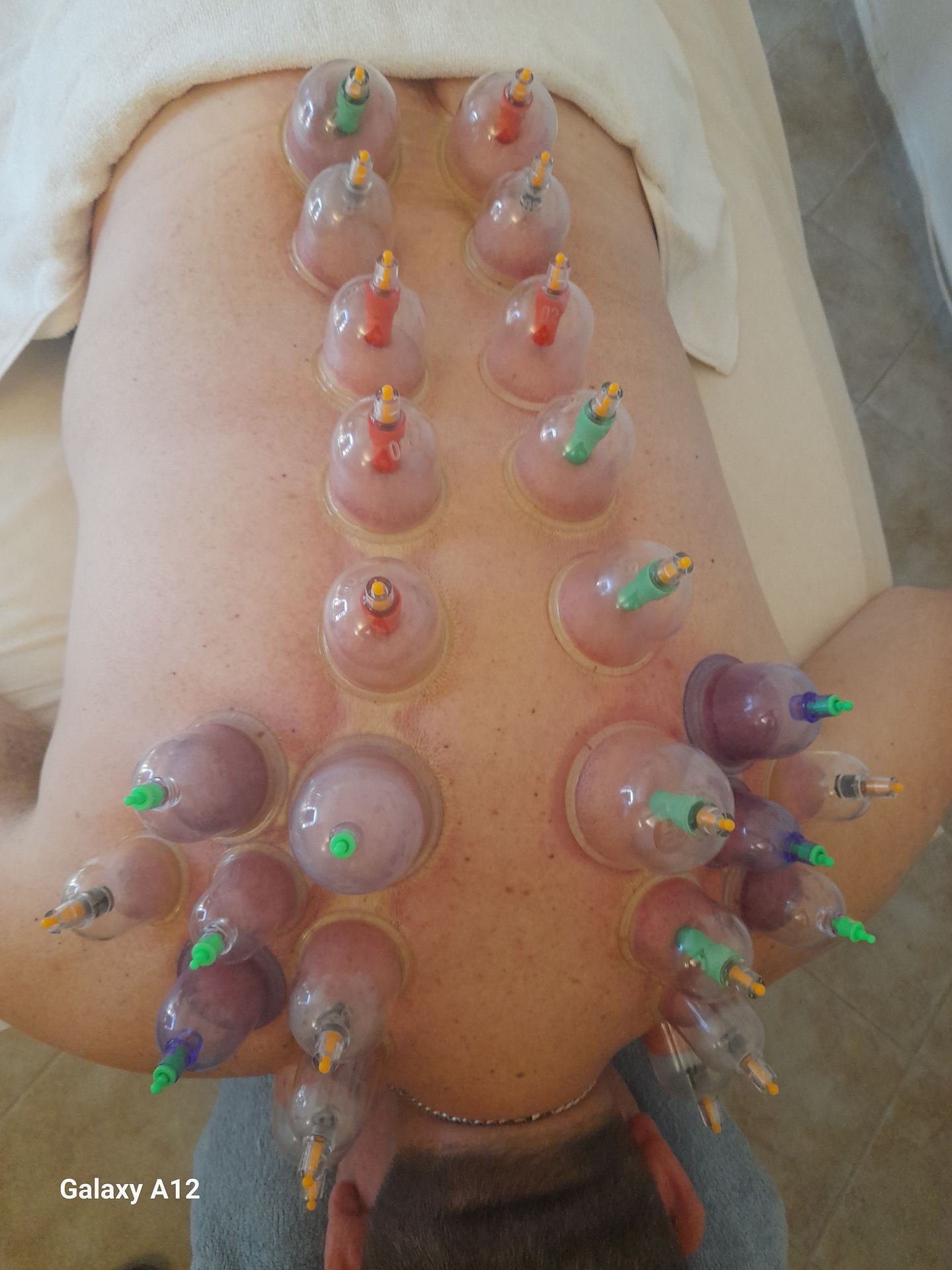 Person lying face down with multiple cupping therapy cups on their back.